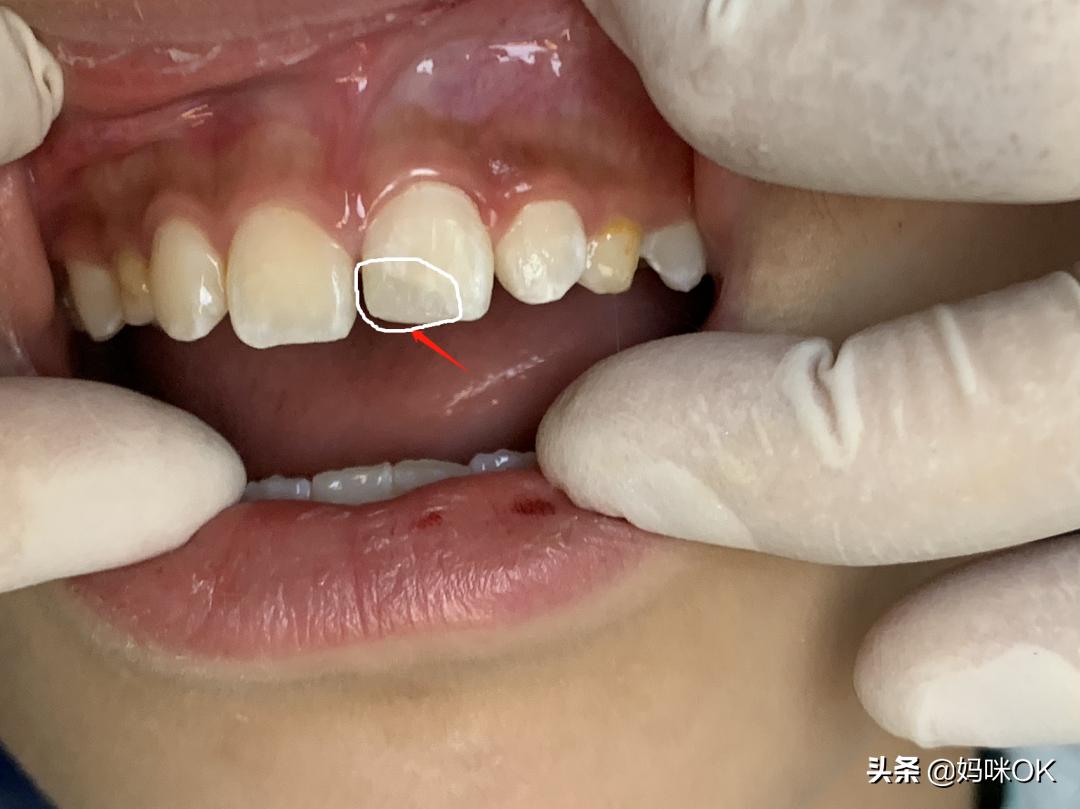 18岁前不能再用门牙吃东西！儿子的这一跤摔得有点惨痛