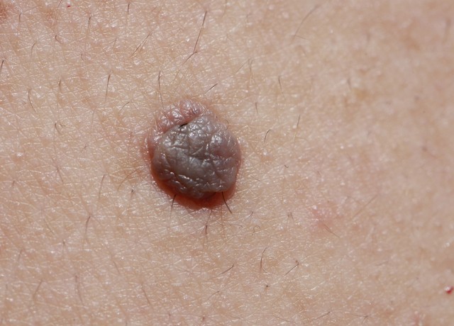 男人脖子上长了瘊子是hpv引起的吗,身上五种疣可能是hpv感染