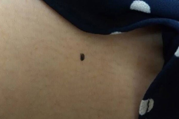 如何鉴别普通痣和黑色素瘤,如何分辨黑痣和黑色素瘤