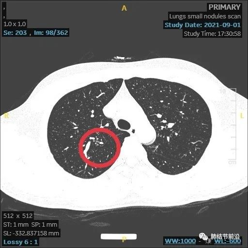 炎症引起的肺实性结节生长速度,肺部结节影像学读片讲解视频