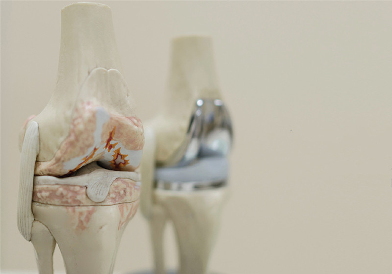 膝关节置换手术风险有哪些,人工膝关节置换术多少天可以下地