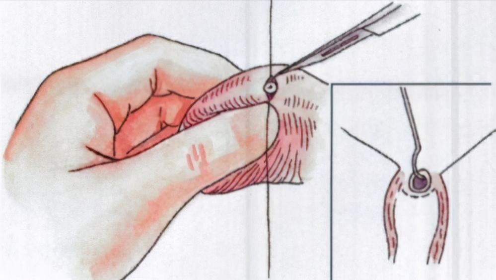 女性取出节育环后多久可以怀孕,节育环在体内有年限吗