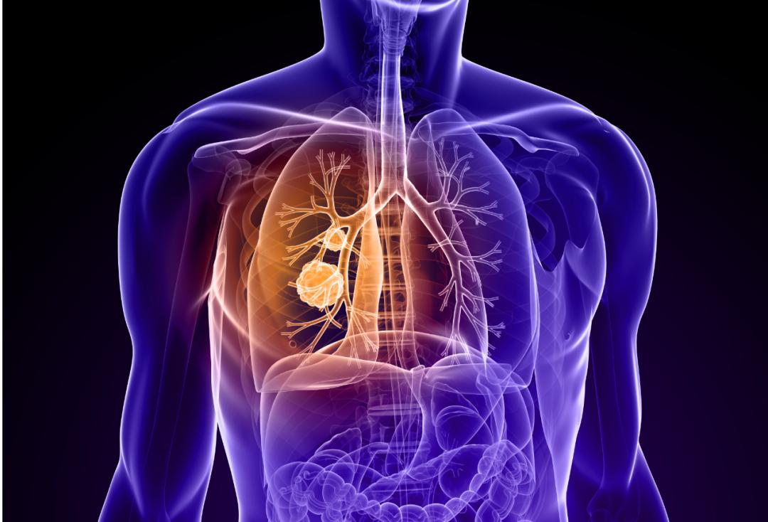 浙江首例！医生用钝头微波消融针为8旬老人“烫死”高危肺结节