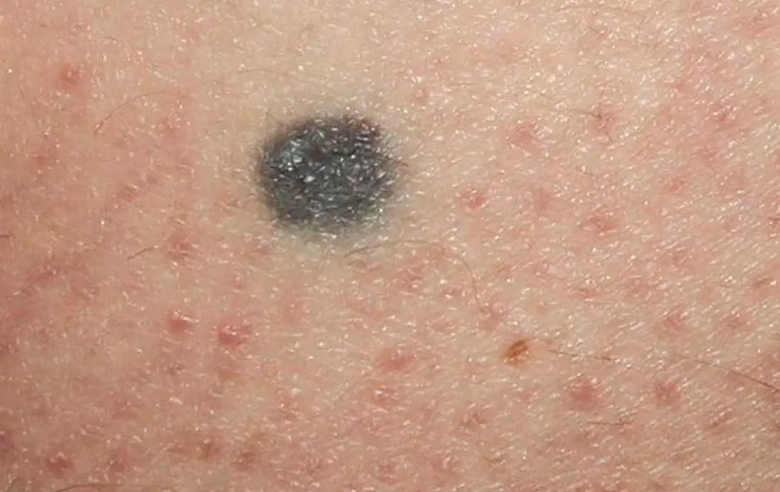 脸上长黑色素痣怎么回事,脸上黑色素痣凸起会痒