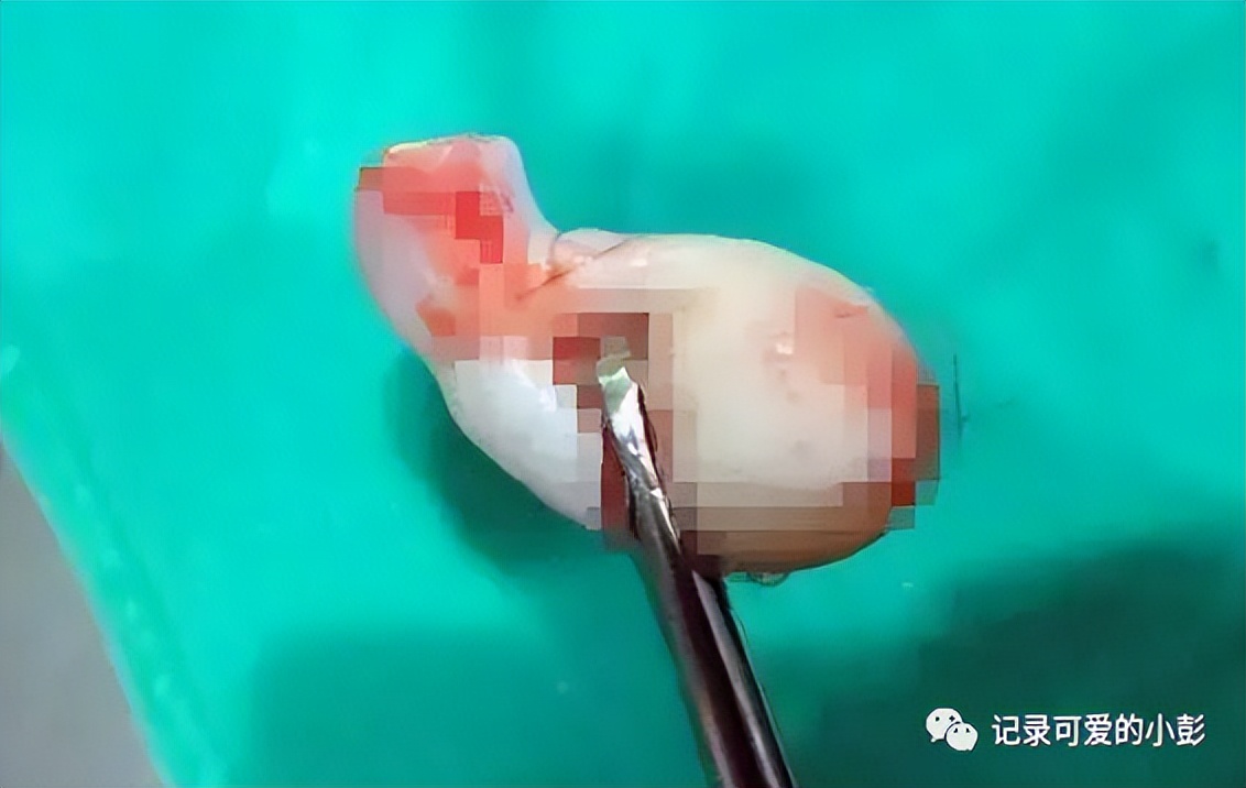 32岁宝妈生二胎子宫掉出来了,孕早期掉出肉球