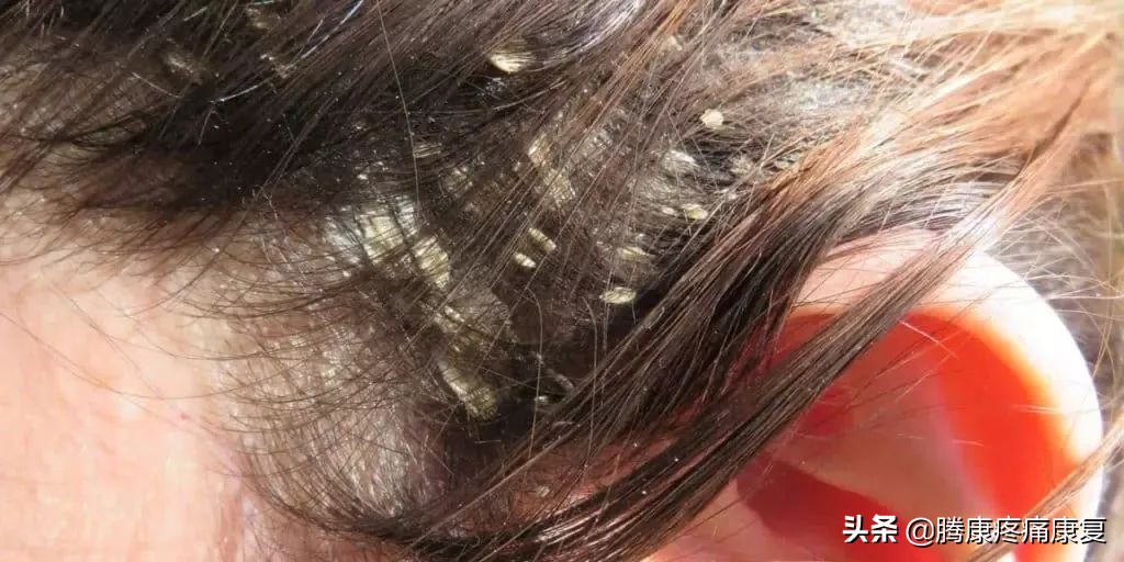 神经性湿疹简单的自愈方法,湿疹病理治疗特效药