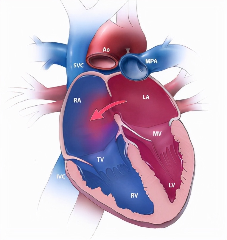 心脏手术疤痕一半增生一半没增生,心脏手术20年疤痕能修复吗