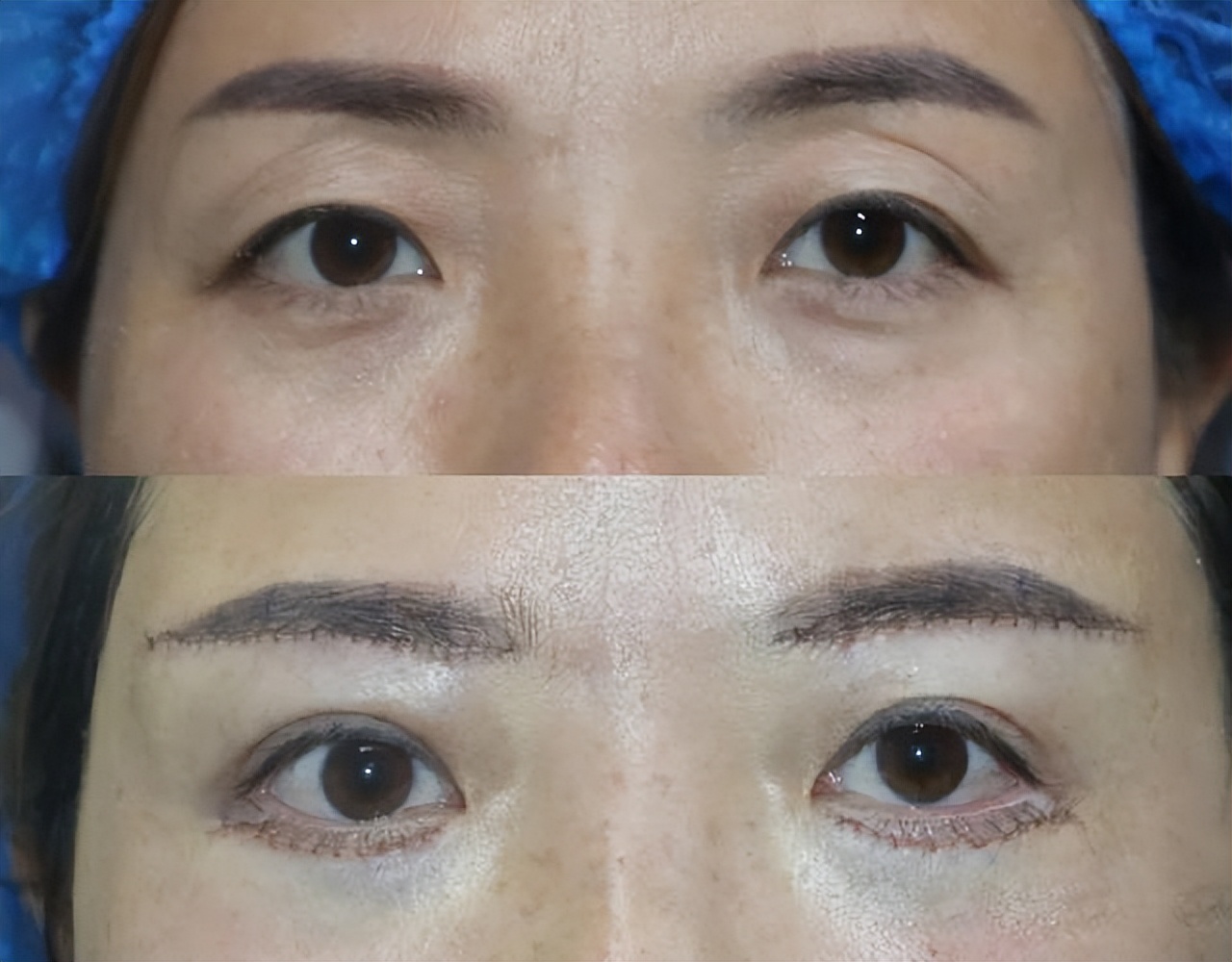 作为做过眼袋手术的过来人,做过提眉的感触