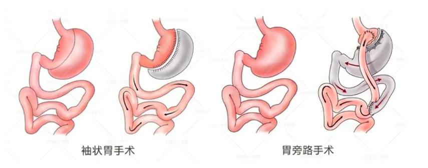 “切胃”火了,但大多数人都不理解这件事