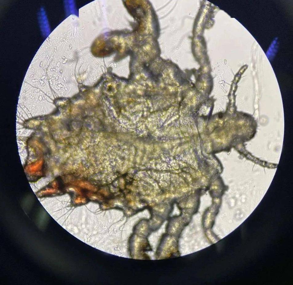 女子腹部痒，医生用镊子夹出16只阴虱！原来阴虱有4个传播途径