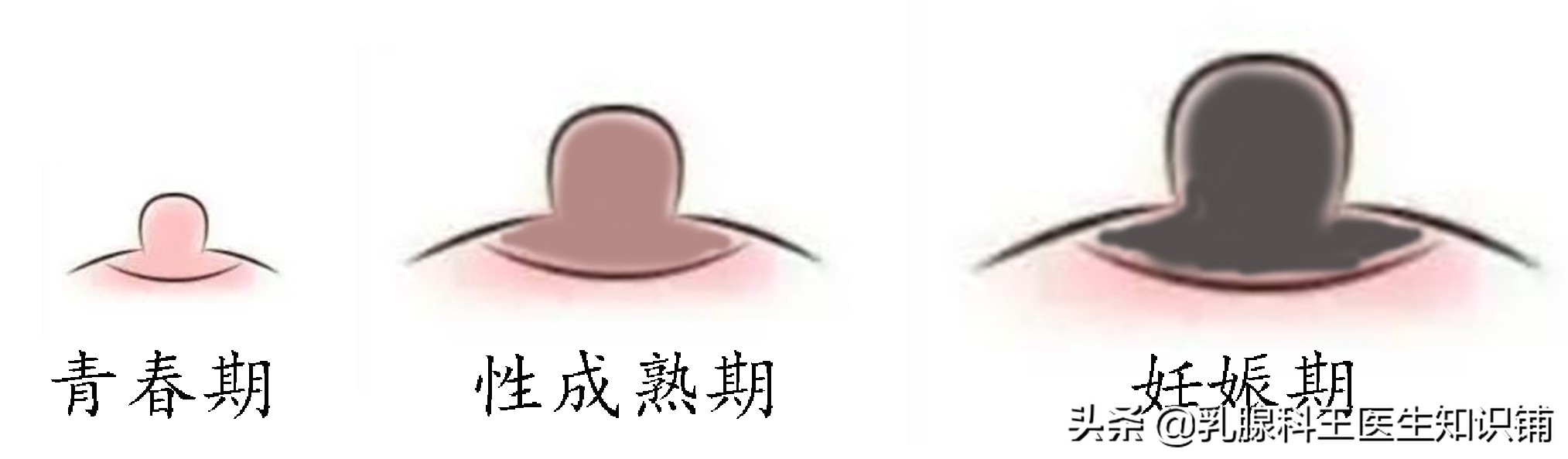 你必须知道！原来“乳头内陷”的危害这么大