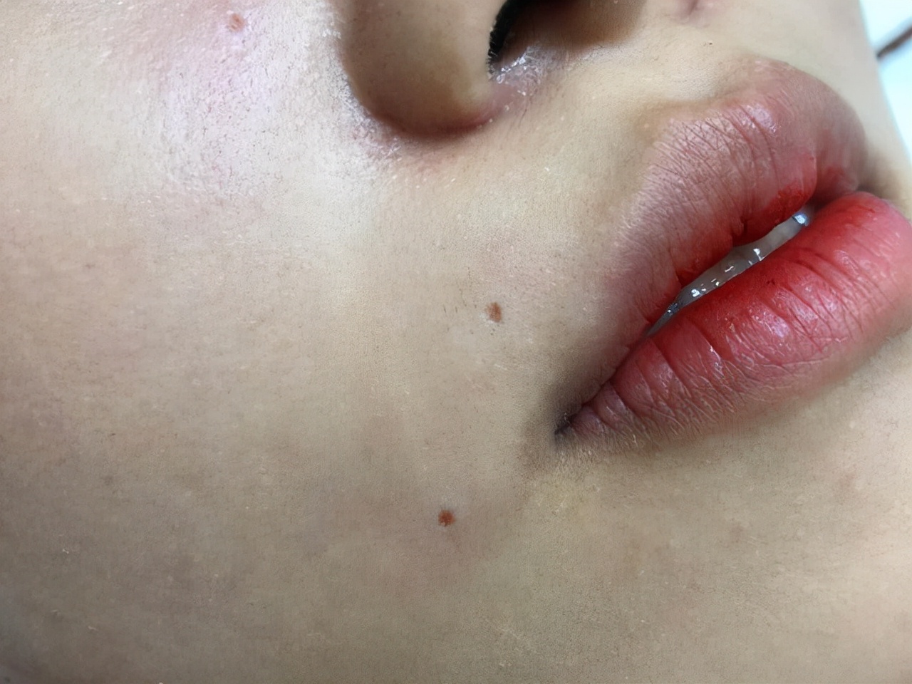 留意黑痣癌变五个重要形态,黑痣比较大才需要引起重视吗