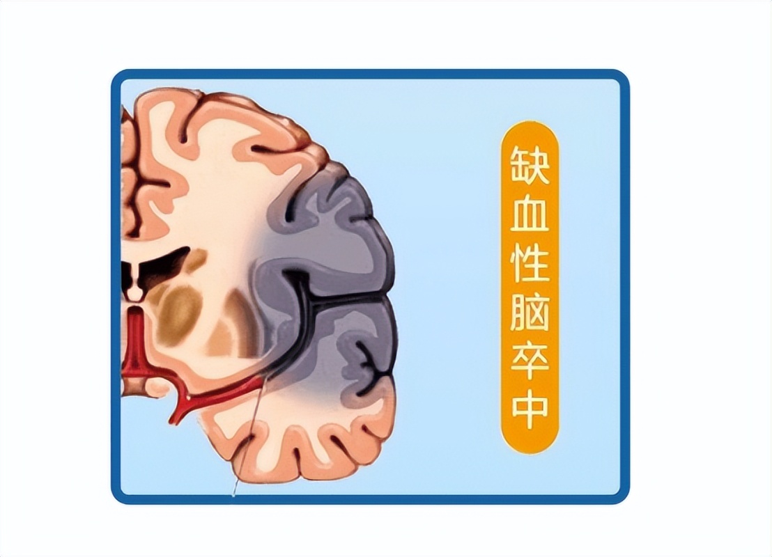 缺血性脑卒中中医治疗原则,急性缺血性脑卒中诊治指南最新版