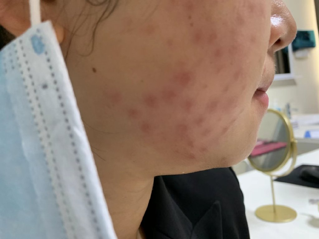 注射完后针眼溃烂怎么办,注射后针孔发炎怎么处理