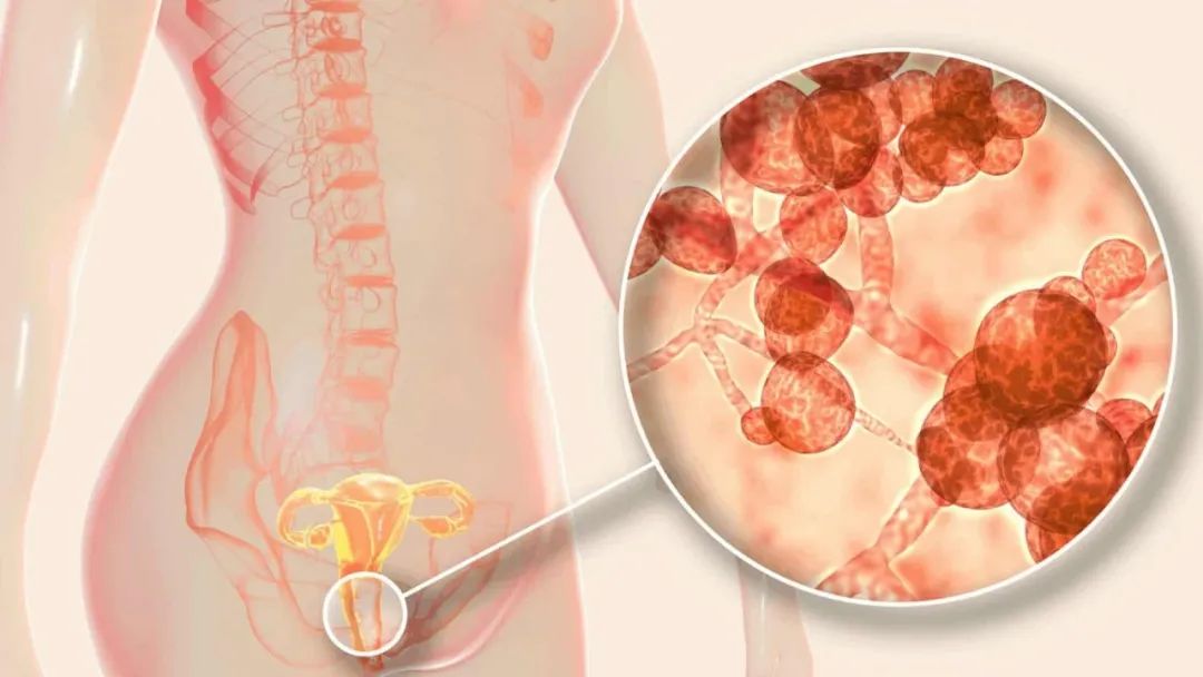 酵母菌过度生长,酵母菌感染是什么原因