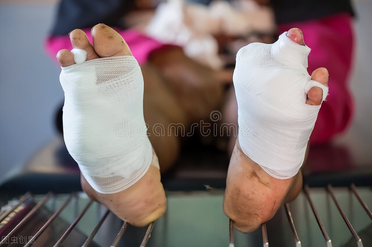 血栓引起的脚趾头坏死,脉管炎脚趾头坏死化脓