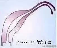 罕见女子2个子宫同时怀孕,罕见龙凤三胞胎