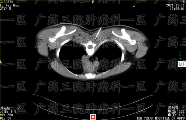 乳房有肿块良性用切除吗,乳房有肿块需要吃药吗