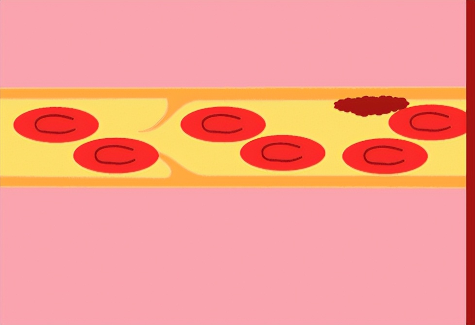 股骨头坏死为什么总觉得困啊,为什么股骨头坏死腿会无力