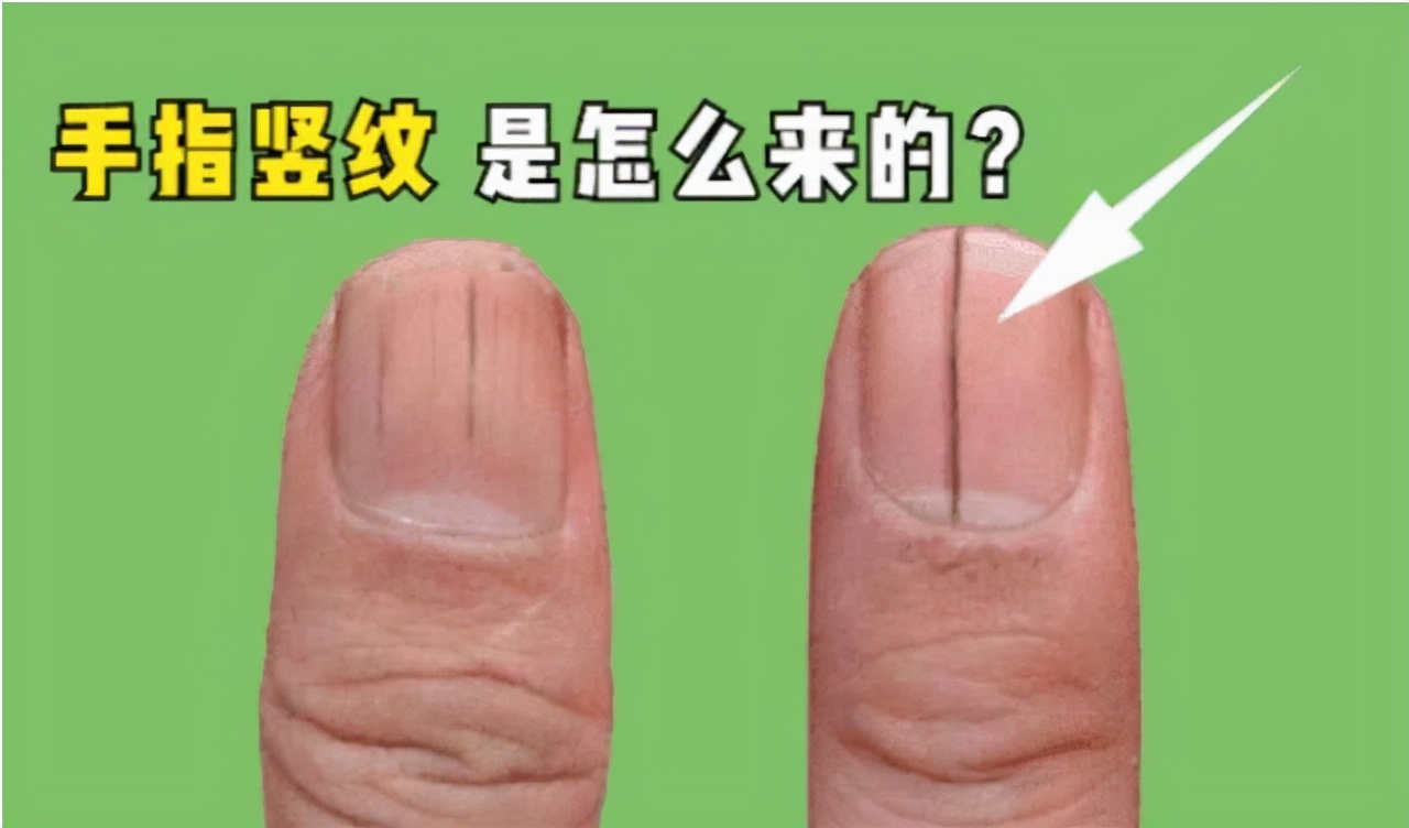 指甲有竖条纹是什么病,指甲有竖条纹的原因和危害