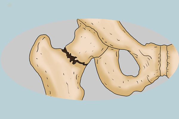 高蛋白食物促进骨折愈合吗,骨折需补钙吃哪种食物更有效