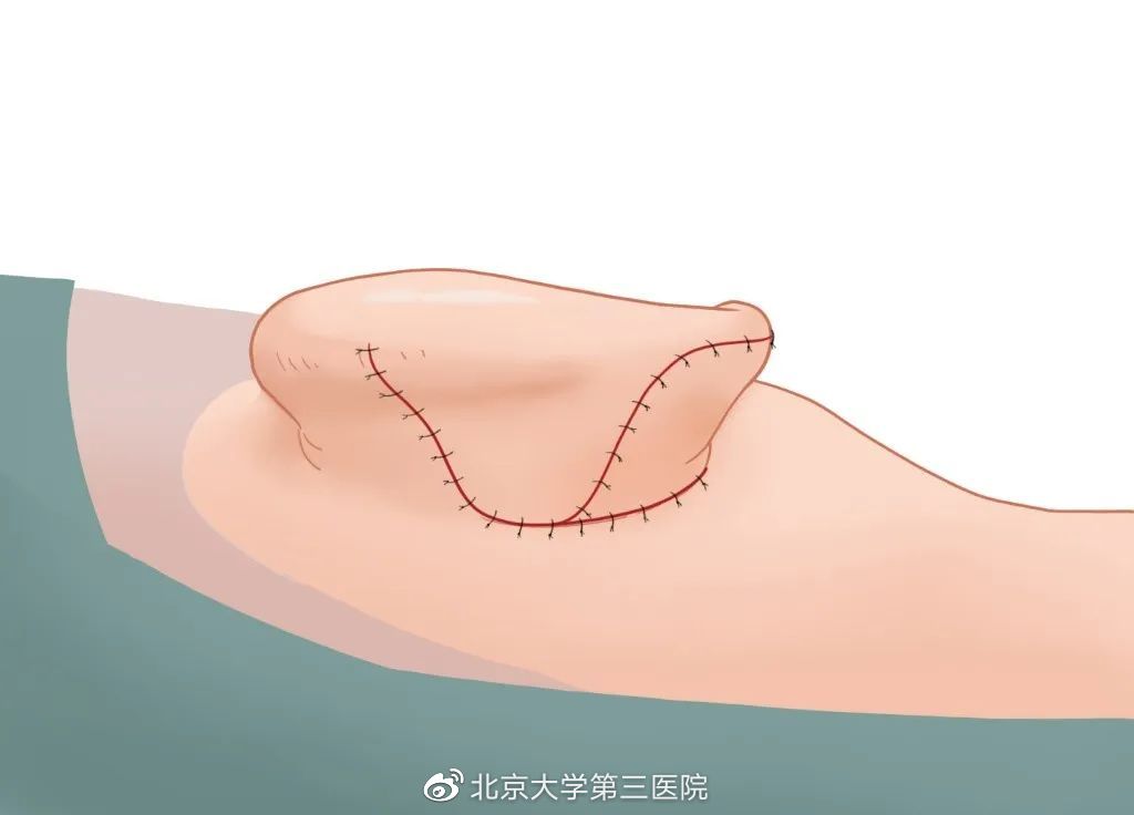 意外留疤怎么安慰,眉尾意外受伤留疤好不好