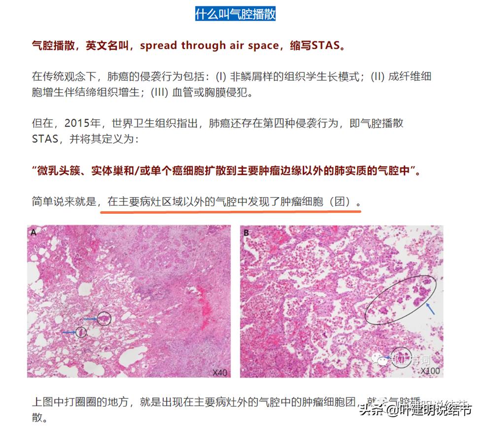 肺腺癌高危亚型什么意思,肺腺癌高危亚型