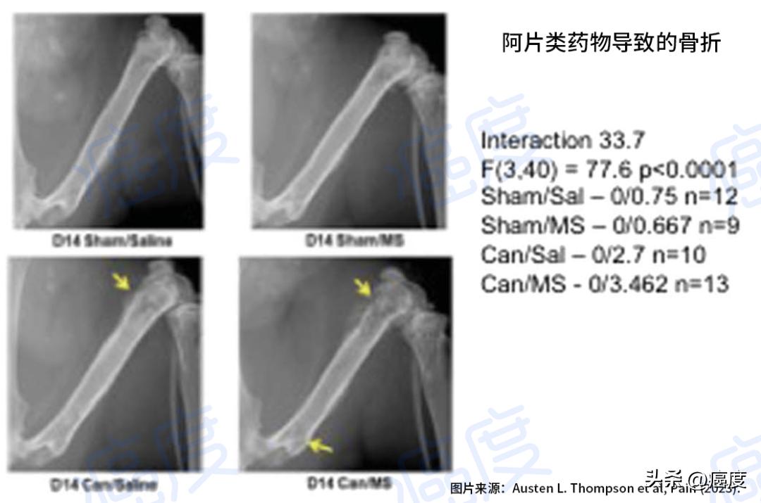 没看错？止痛药引发疼痛，错用*啡吗**引发骨流失和骨痛