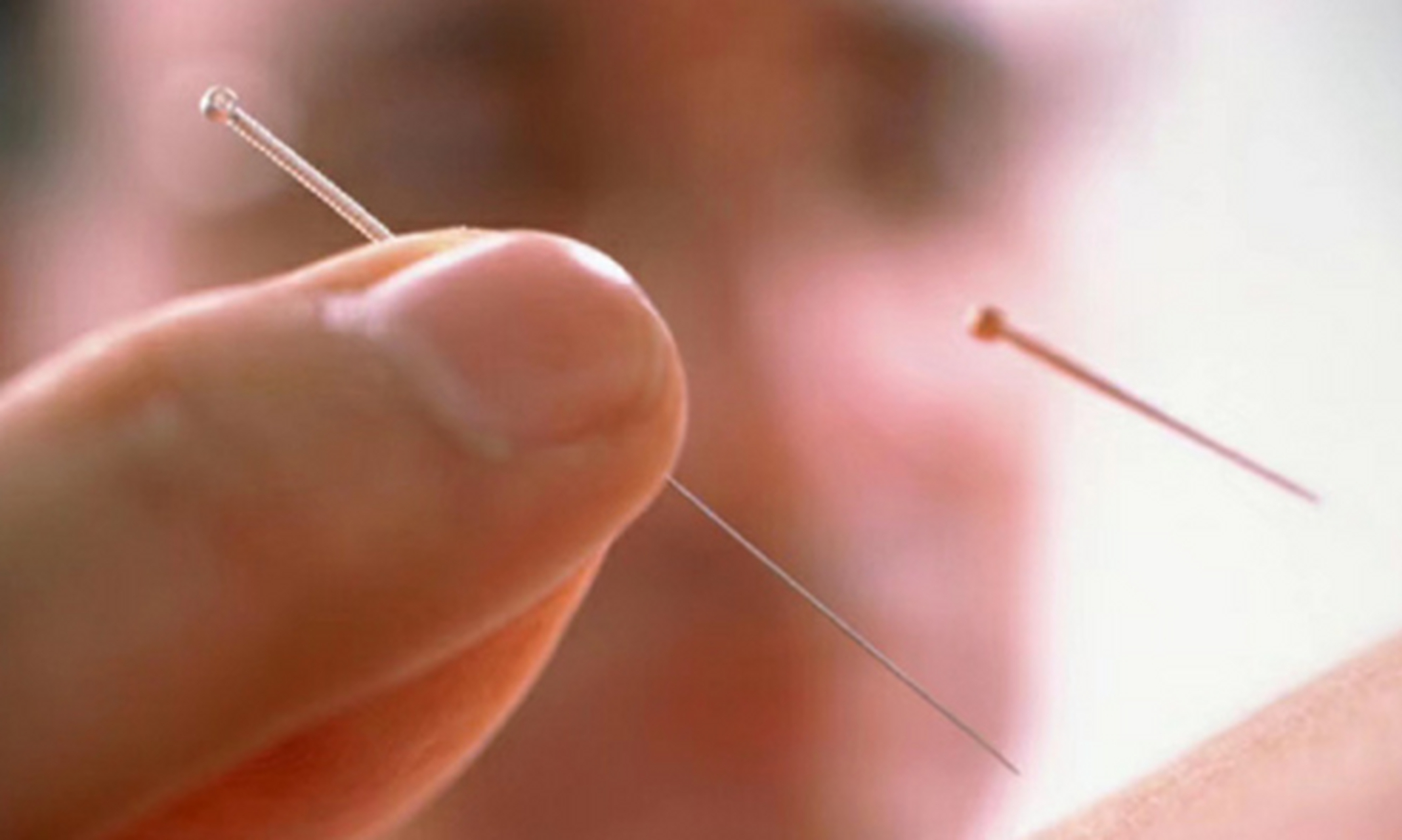 针灸临床经验选编精华,古法针灸临床治验