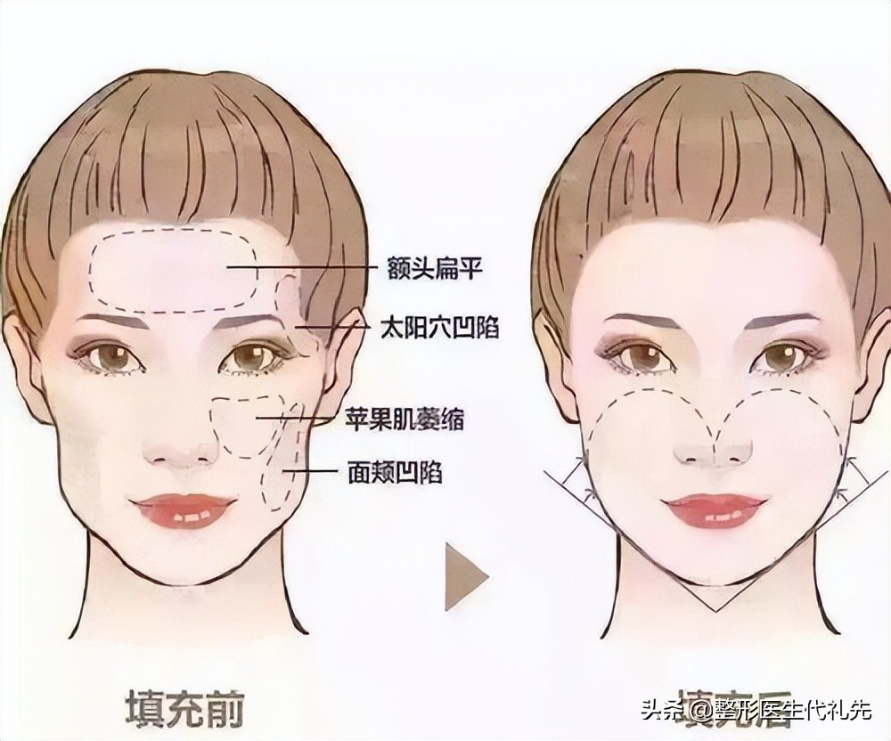 脸宽面部凹陷整形能恢复吗,面部皮肤下垂怎样整形修复
