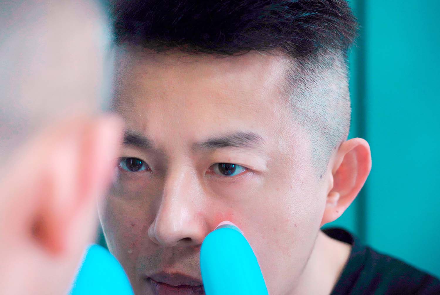 doco小气泡去黑头蓝光版,doco小气泡黑头仪案例