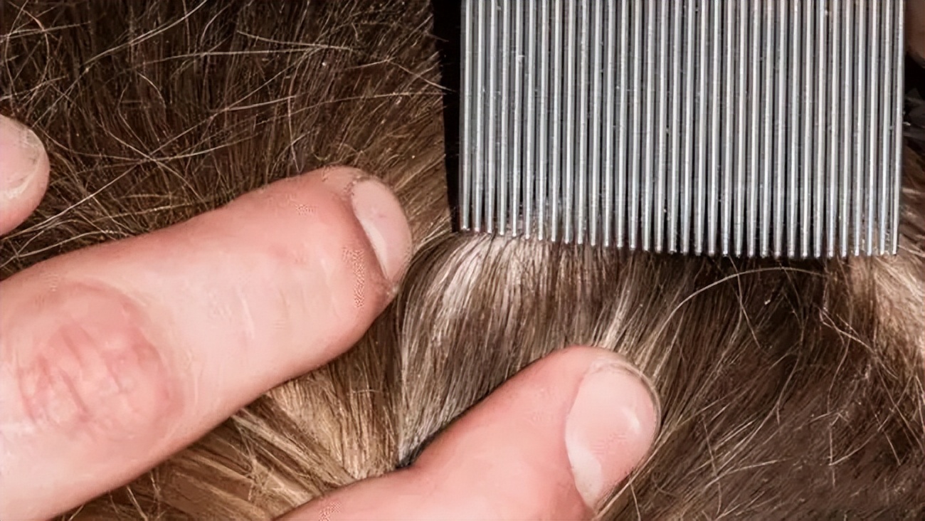 曾经无孔不入的虱子是怎么来的？为何如今很少看到了？