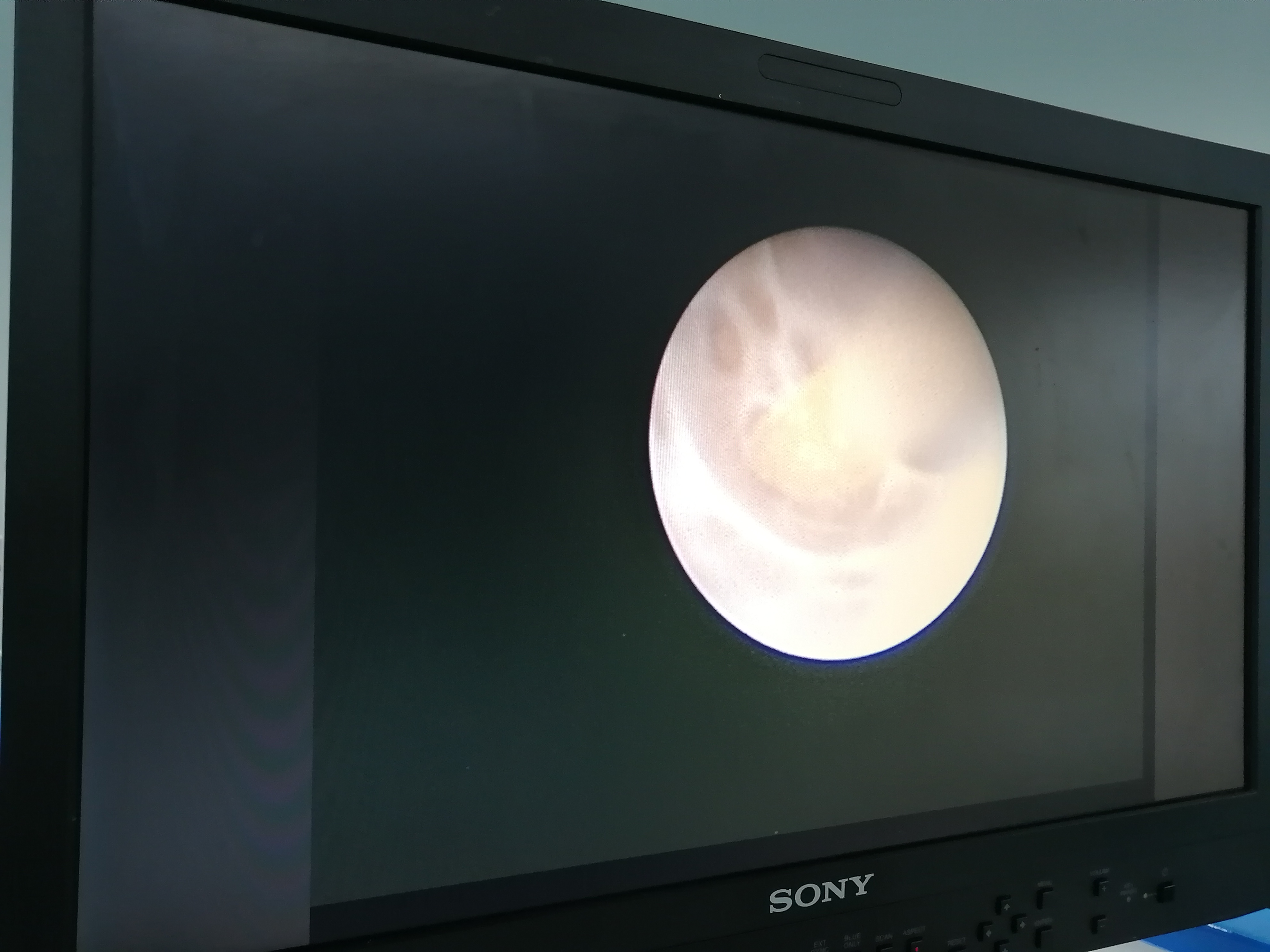 顽固性血精什么样子,什么叫顽固性血精