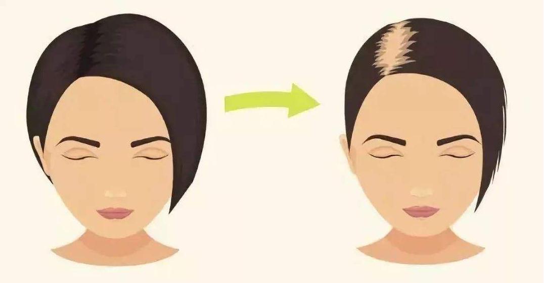 脱发严重教你一招,脱发严重的烦恼怎么解决