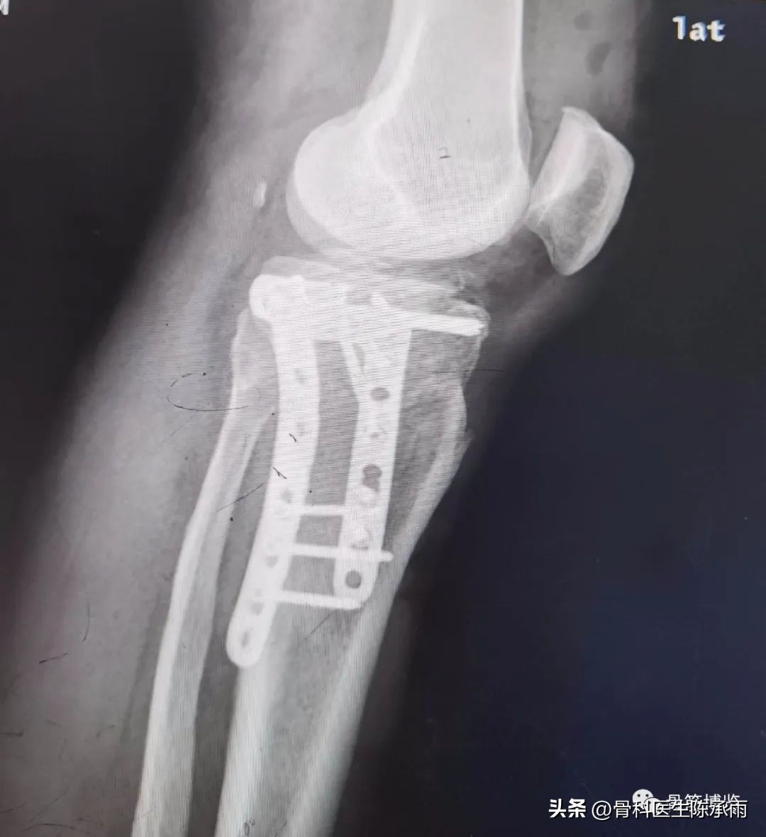 膝关节胫骨平台骨折,最近胫骨平台骨折视频