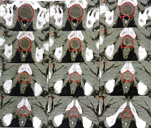 前列腺癌放疗部位,晚期前列腺放疗靶区