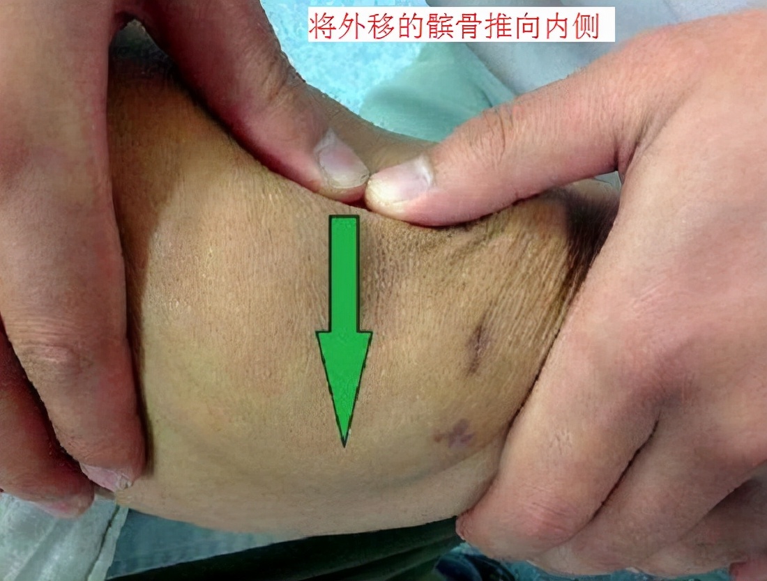 髌骨软化症治疗方法以及康复训练,髌骨软化症康复训练方法