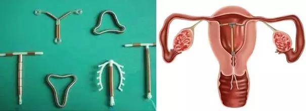 体内有金属植入患者怎么做核磁,体内有植入物可以做磁共振检查吗