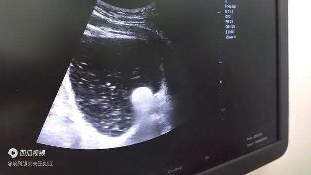 孔院长解读：什么是尿道疏通扩张术？配合前列腺钙化消融术...