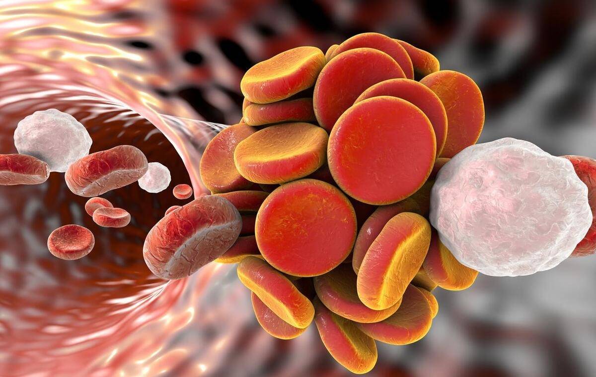 动脉瘤蛛网膜下腔出血术后并发症,动脉瘤导致蛛网膜下腔出血严重吗