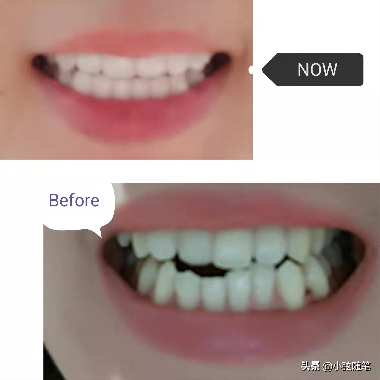 隐形矫正牙齿一万多,牙齿矫正和隐形牙齿矫正的全过程