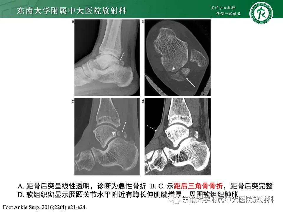 好文分享-《肌骨系统疾病——副舟骨综合征》