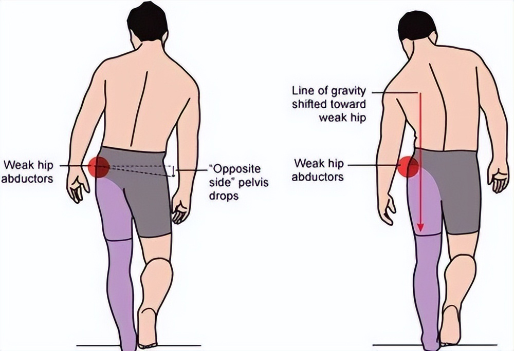 走路像鸭子是哪块肌肉的问题,走路像鸭子一样的是什么原因