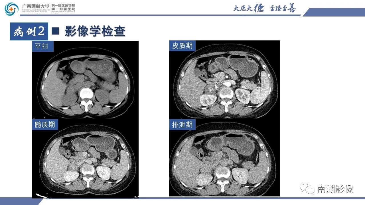 肾上腺海绵状血管瘤,肾上腺血管瘤是良性还是恶性