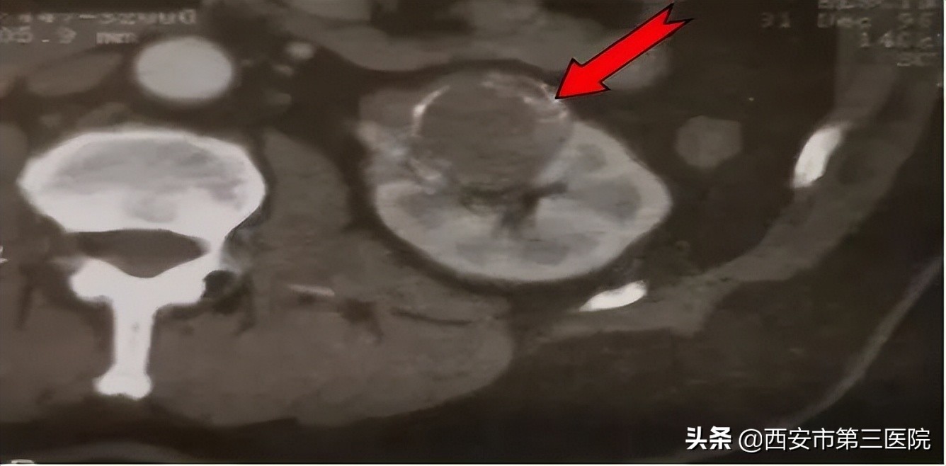 肾囊肿跟肿瘤有什么区别,囊肿在检查过程中破了会怎样