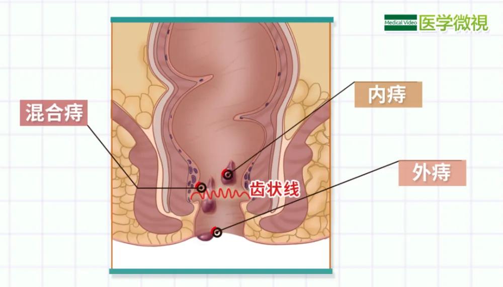 痔疮的诊疗（诊断/实用总结一）