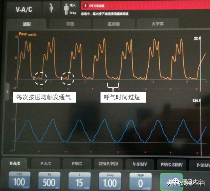 呼吸机：报警设置、心脏按压时的呼吸机设置