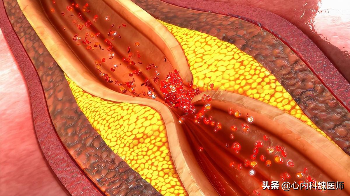 心肌缺血吃什么药效果更好,心肌缺血一般吃什么药可以缓解