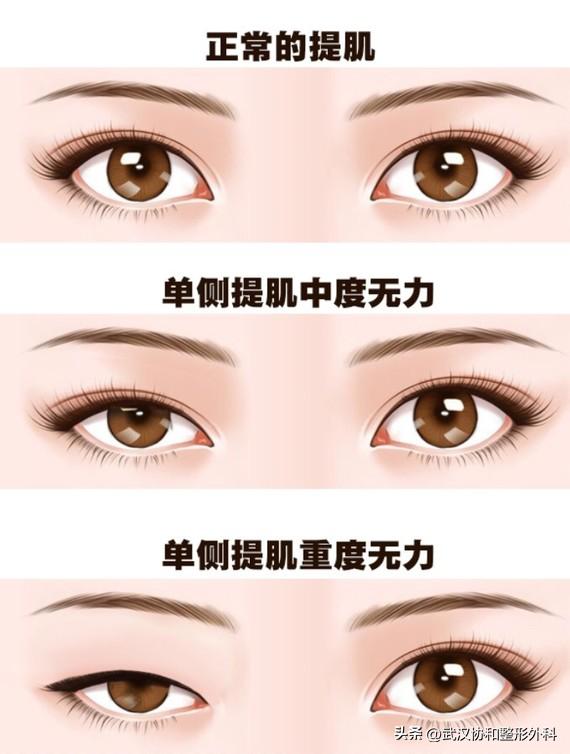 平行双眼皮手术图片,埋线双眼皮手术价格