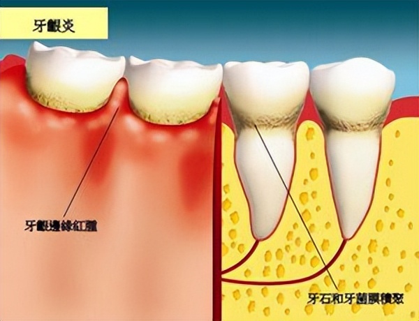 牙痛的最快止痛方法没有药吃,牙痛除了吃止痛药还有什么方法